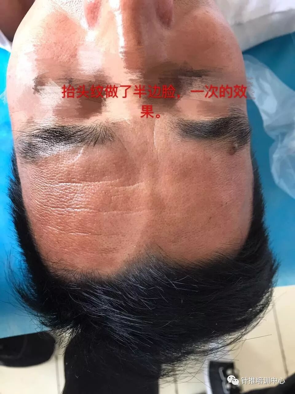 18,0.20普通毫针,安全可靠无刃针,无创伤.