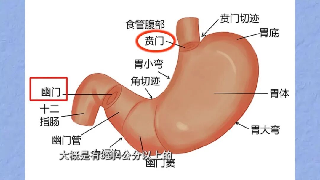 1.22《养生大国医》“保胃”手术有哪三种术式？什么是胃癌保功能“长颈鹿”手术？和传统全切术相比，它有什么优势？[00-01-15][20260122-171330559].jpg