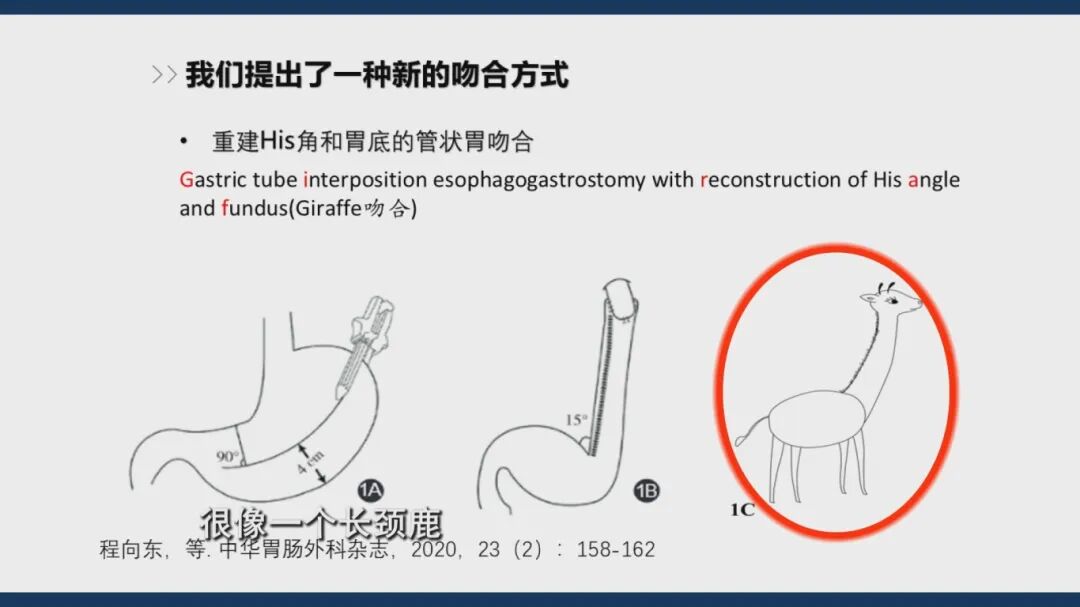 1.22《养生大国医》“保胃”手术有哪三种术式？什么是胃癌保功能“长颈鹿”手术？和传统全切术相比，它有什么优势？[00-03-22][20260122-171444699].jpg
