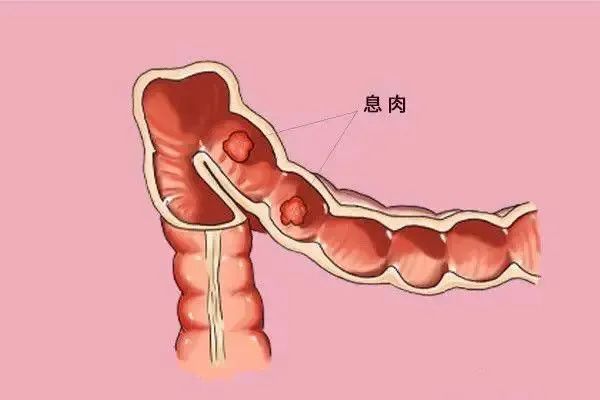 腸癌大多是拖出來的你想知道的腸鏡檢查常見問題都在這裡