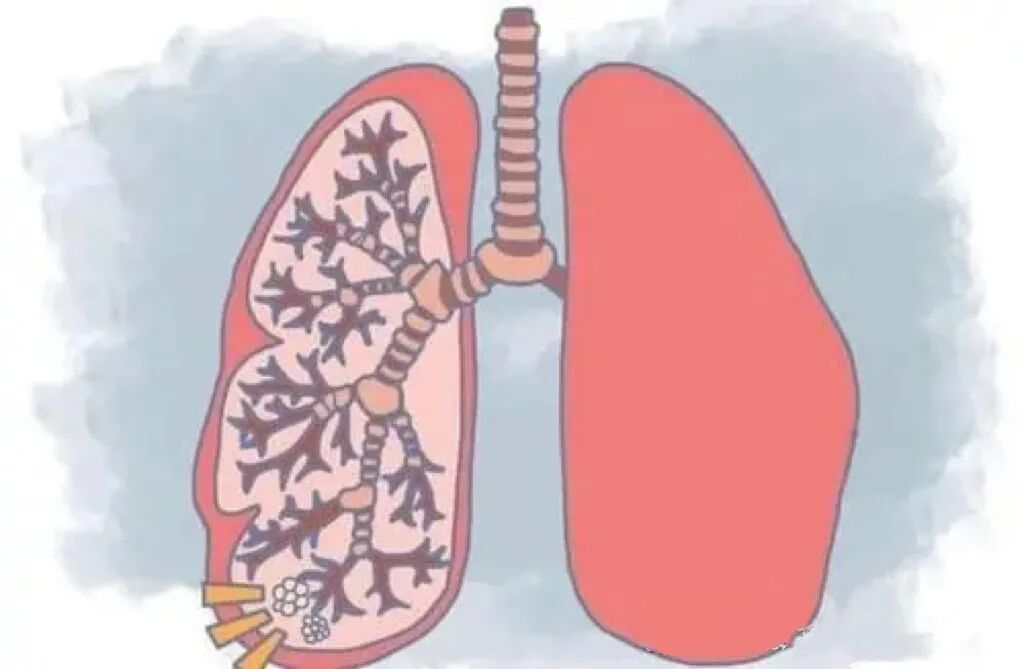 一文看懂老慢支肺气肿及慢阻肺的区别识别症状相似却易混淆的呼吸系统
