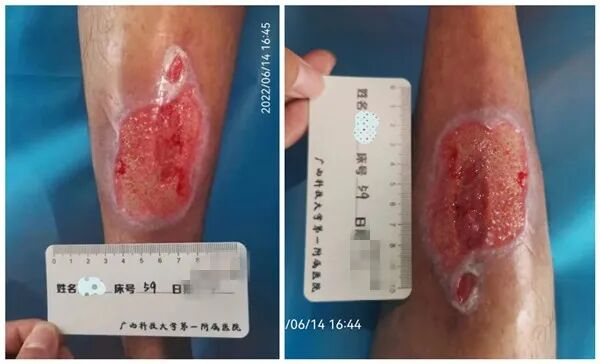 为什么负压引流“抓痒”有风险，修脚需谨慎-----真空负压封闭引流术治愈严重皮肤溃疡_https://www.jmylbn.com_新闻资讯_第3张