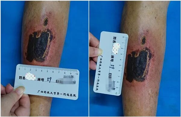 为什么负压引流“抓痒”有风险，修脚需谨慎-----真空负压封闭引流术治愈严重皮肤溃疡_https://www.jmylbn.com_新闻资讯_第2张