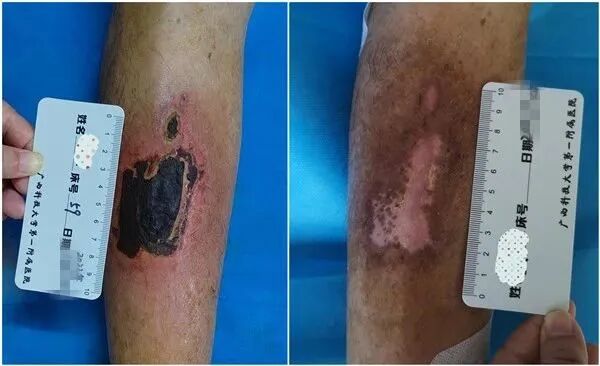 为什么负压引流“抓痒”有风险，修脚需谨慎-----真空负压封闭引流术治愈严重皮肤溃疡_https://www.jmylbn.com_新闻资讯_第4张