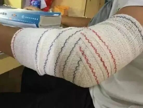 医用绷带怎么绑图解健康科普：急救医生教您几种简易绷带包扎方法_https://www.jmylbn.com_新闻资讯_第13张