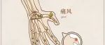 痛风发作生不如死，一个中医小方子帮你缓解