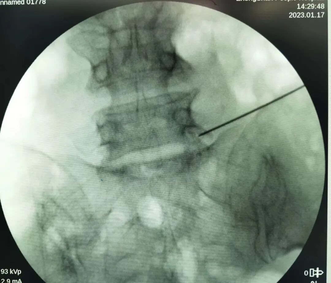 开刀孔怎么开刀椎间孔镜手术技术，不开刀解决腰腿疼痛_https://www.jmylbn.com_新闻资讯_第10张