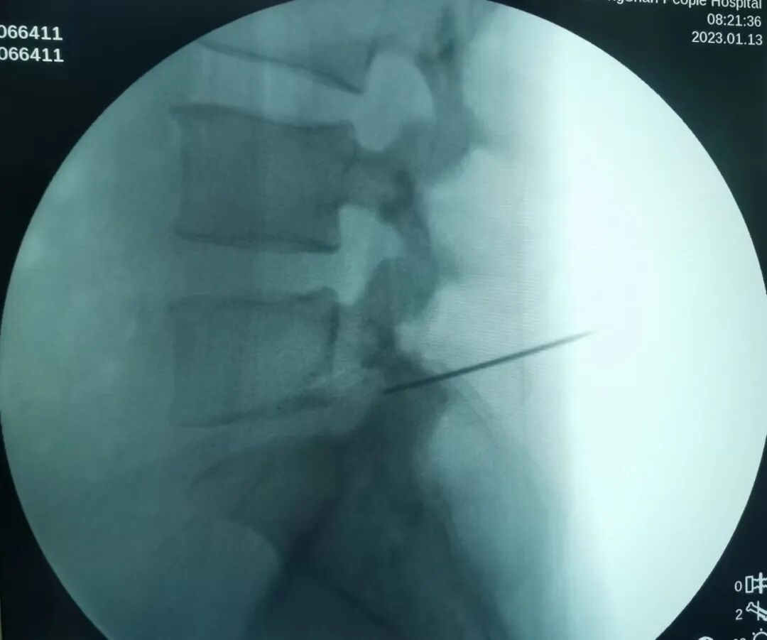 开刀孔怎么开刀椎间孔镜手术技术，不开刀解决腰腿疼痛_https://www.jmylbn.com_新闻资讯_第11张