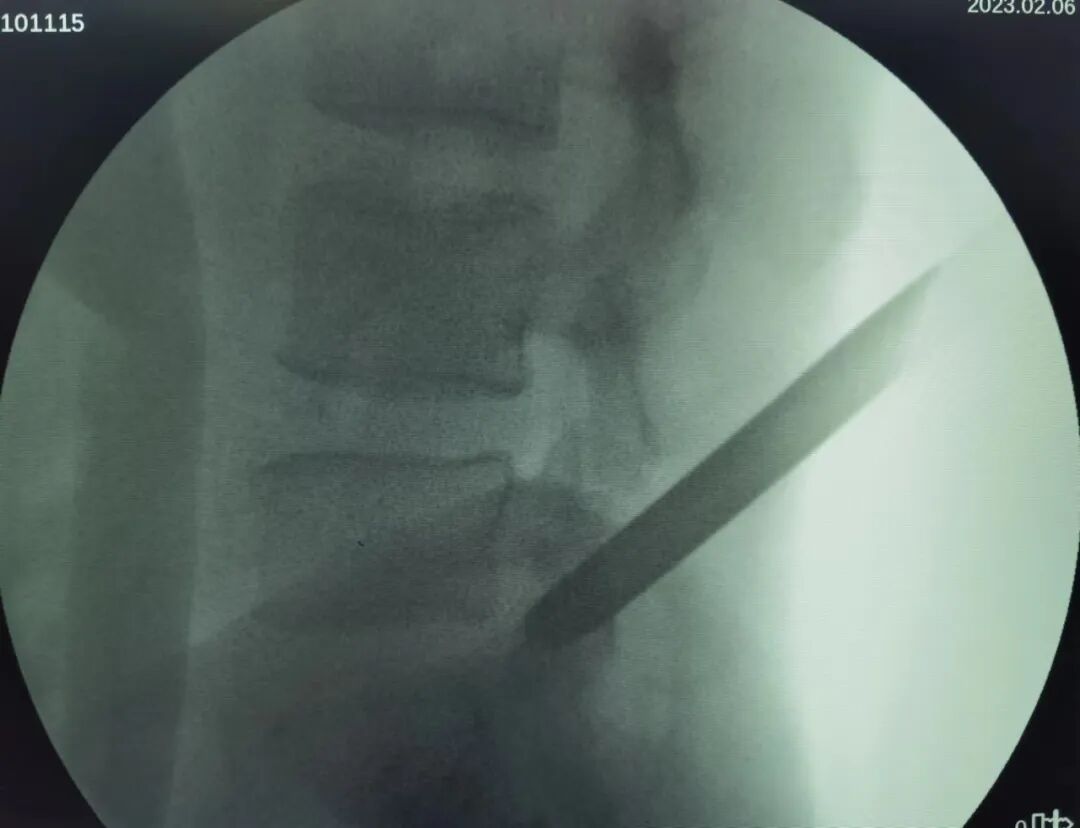 开刀孔怎么开刀椎间孔镜手术技术，不开刀解决腰腿疼痛_https://www.jmylbn.com_新闻资讯_第13张