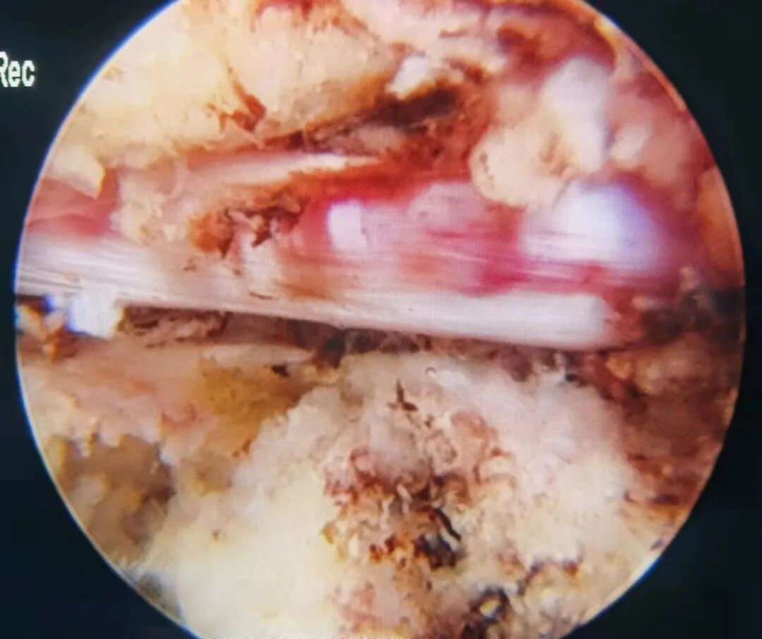 开刀孔怎么开刀椎间孔镜手术技术，不开刀解决腰腿疼痛_https://www.jmylbn.com_新闻资讯_第14张