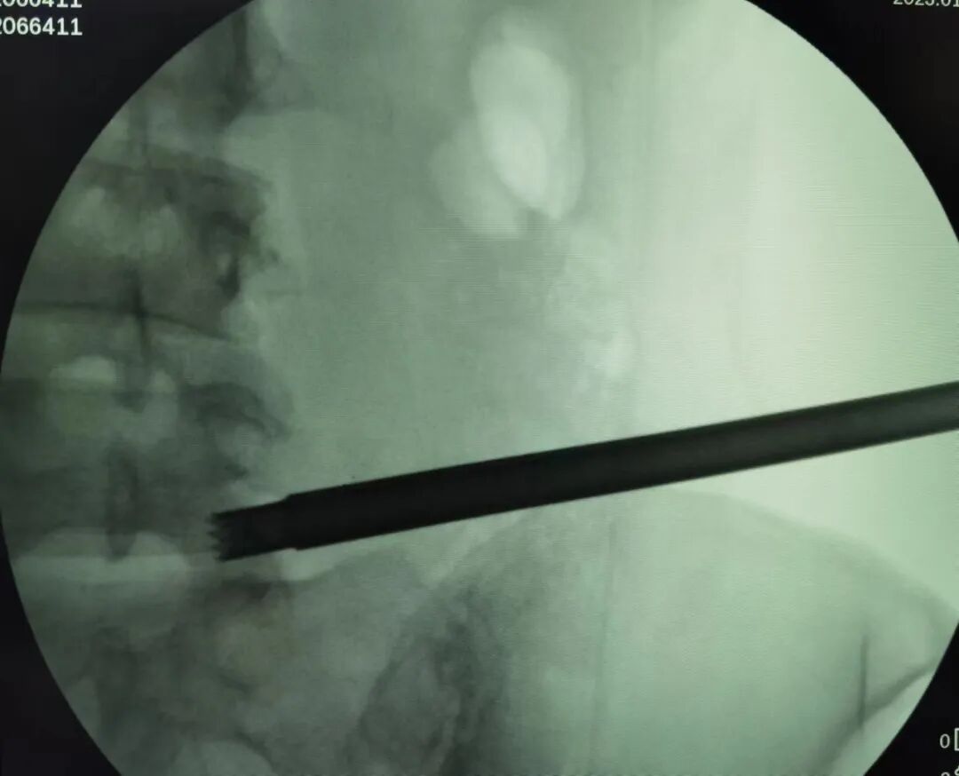 开刀孔怎么开刀椎间孔镜手术技术，不开刀解决腰腿疼痛_https://www.jmylbn.com_新闻资讯_第12张