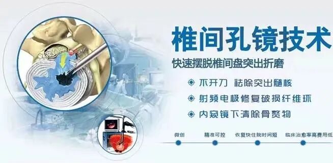 开刀孔怎么开刀椎间孔镜手术技术，不开刀解决腰腿疼痛_https://www.jmylbn.com_新闻资讯_第2张