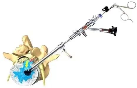 开刀孔怎么开刀椎间孔镜手术技术，不开刀解决腰腿疼痛_https://www.jmylbn.com_新闻资讯_第7张