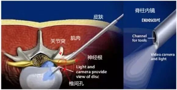 开刀孔怎么开刀椎间孔镜手术技术，不开刀解决腰腿疼痛_https://www.jmylbn.com_新闻资讯_第8张