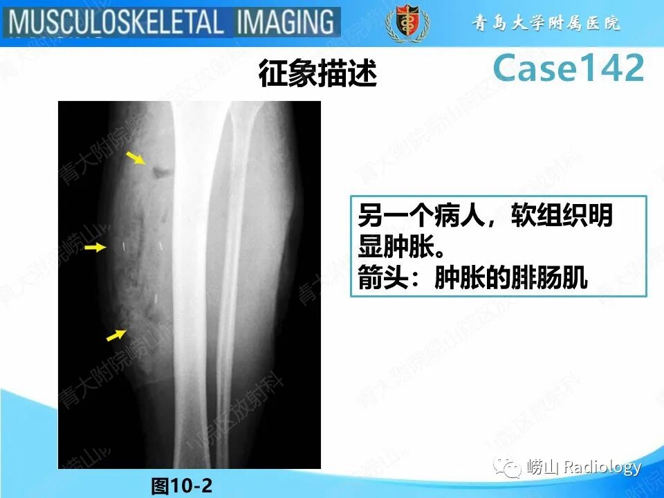 坏死性筋膜炎影像表现