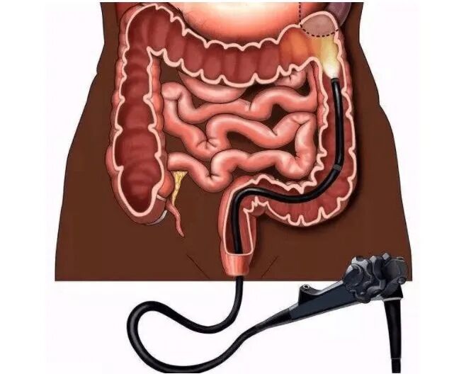 电子胃镜镜是什么一文读懂！“消化道保护神”——电子胃肠镜检查流程_https://www.jmylbn.com_新闻资讯_第16张