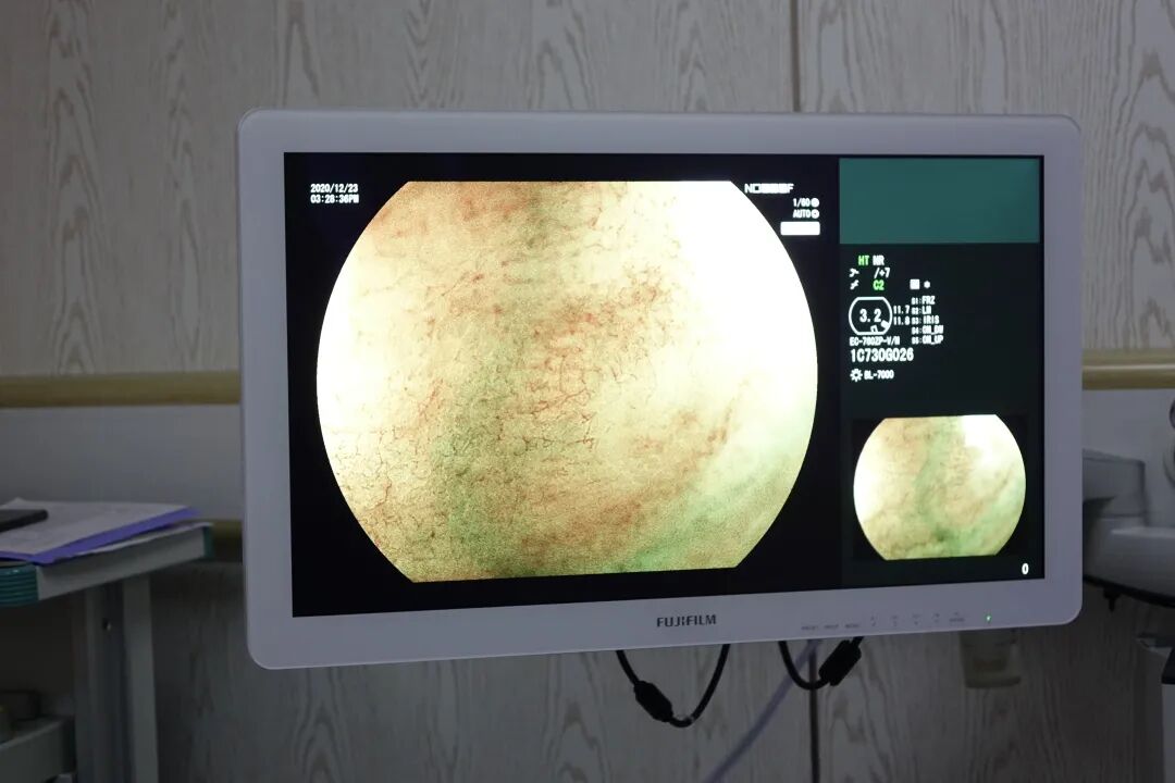 电子胃镜镜是什么一文读懂！“消化道保护神”——电子胃肠镜检查流程_https://www.jmylbn.com_新闻资讯_第9张