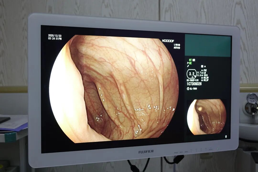 电子胃镜镜是什么一文读懂！“消化道保护神”——电子胃肠镜检查流程_https://www.jmylbn.com_新闻资讯_第14张