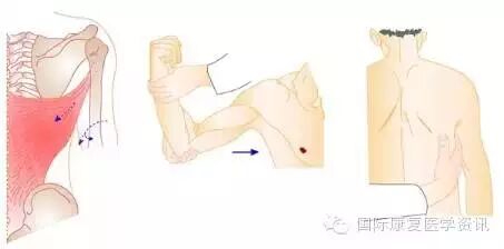 怎么评估病人肌力运动功能检查｜肌力评估_https://www.jmylbn.com_新闻资讯_第12张