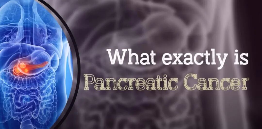 胰腺癌的早期预警信号，你不应该忽视