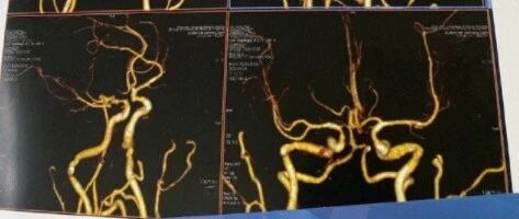 关于动脉瘤，我的复查结果