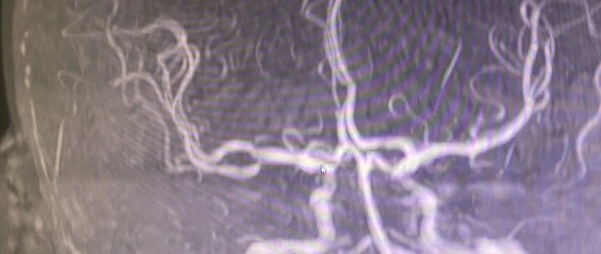 说说我大脑里的动脉瘤