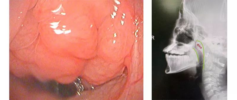 外科胶带怎么撕暑假到了,耳鼻喉科和泌尿外科又要掀起一轮手术狂潮!腺样体/扁桃体切除手术,你家孩子真的需要做吗?_新闻资讯_第7张_活检穿刺产品网 外科胶带怎么撕暑假到了,耳鼻喉科和泌尿外科又要掀起一轮手术狂潮!腺样体/扁桃体切除手术,你家孩子真的需要做吗?_https://www.jmylbn.com_新闻资讯_第7张