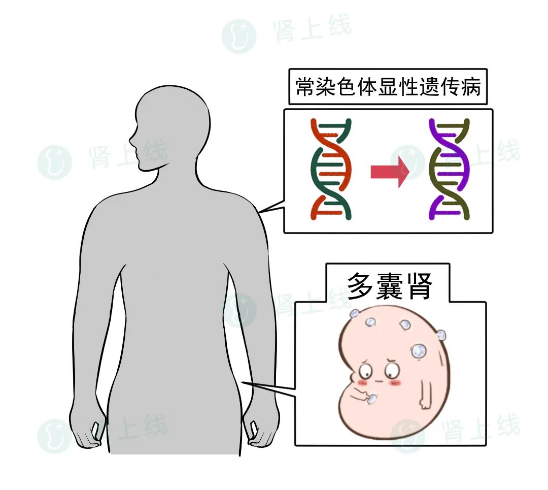 一家人接二连三患尿毒症，到底怎么回事？带你了解最常见的遗传性肾病---多囊肾