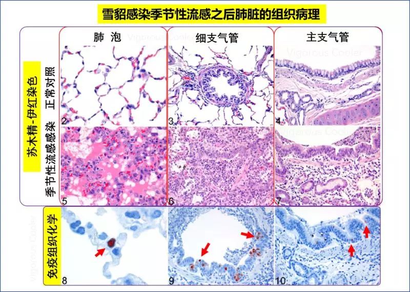 新型冠状病病患者的尸检,能告诉我们什么?(图3) 新型冠状病病患者的尸检,能告诉我们什么?(图3)