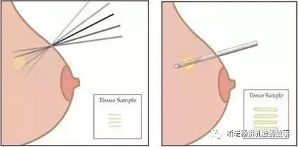 穿刺枪怎么升级乳腺穿刺术（三）_https://www.jmylbn.com_新闻资讯_第74张