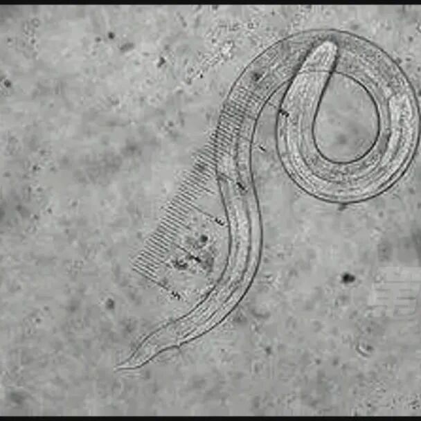 全球仅3000多例！小伙脑中布满虫子，竟因平常这个习惯…