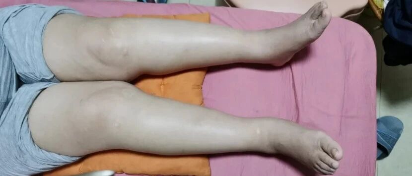 女子吃药治病，结果手脚“变形”险瘫痪！家有老人要警惕