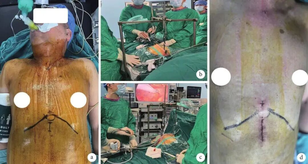 s拉钩怎么用“天平拉钩经皮悬吊技术体系”介绍_https://www.jmylbn.com_新闻资讯_第5张