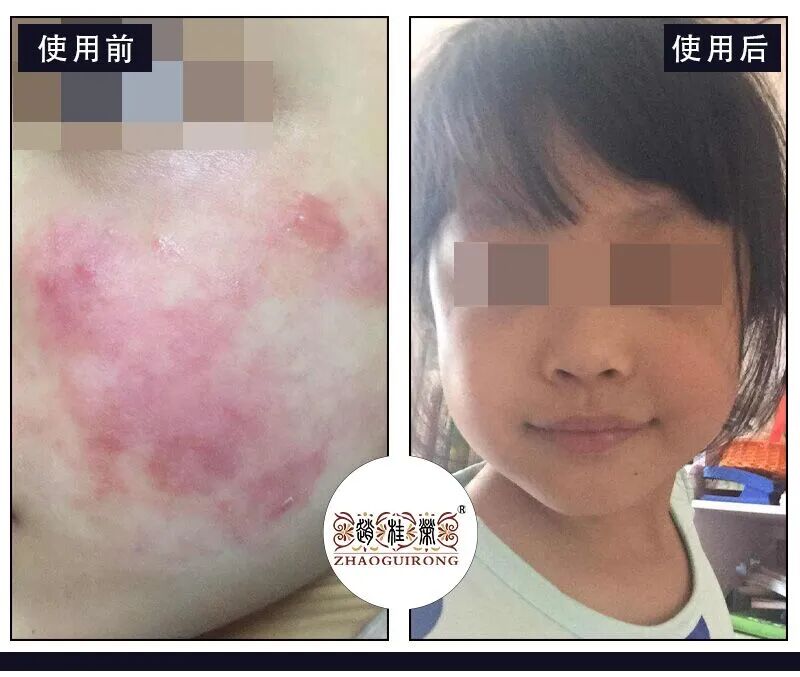 医用冷敷凝胶怎么用械字号“儿童产品”被曝违禁添加氯倍他索丙酸酯（激素）！看看你家娃用没用！_https://www.jmylbn.com_新闻资讯_第6张