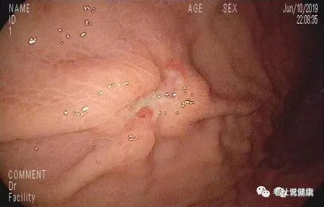 15岁孩子，全胃像鸡皮一样，长满小疙瘩，医生说：这种胃炎易癌变！