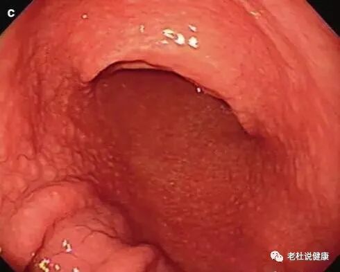 15岁孩子，全胃像鸡皮一样，长满小疙瘩，医生说：这种胃炎易癌变！