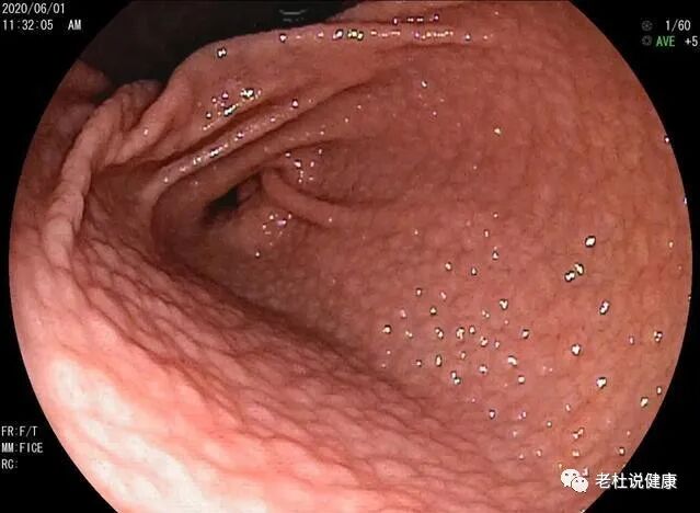 15岁孩子，全胃像鸡皮一样，长满小疙瘩，医生说：这种胃炎易癌变！