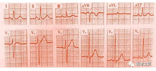 心电监护怎么看图图文并茂最全心电图，值得转发收藏_https://www.jmylbn.com_新闻资讯_第9张