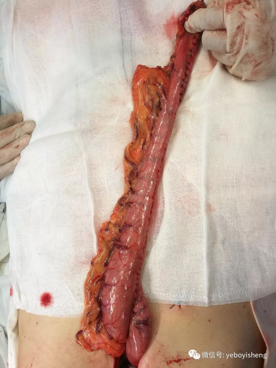 对管状胃的误解