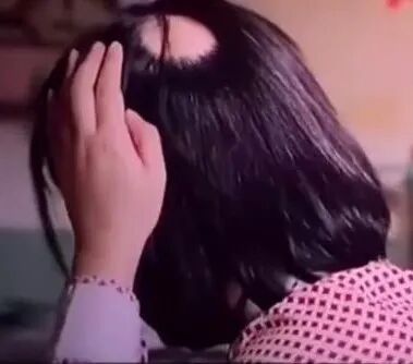 一夜之间娃秃了！——斑秃不是“鬼剃头”