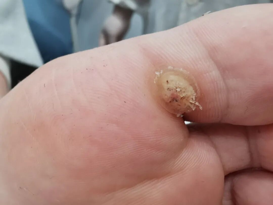 孩子脚底长了硬疙瘩是鸡眼还是疣