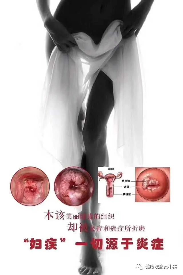 护阴器是什么东西私密处干涩？贡小美草本凝胶，让你不再为“水”干涸_https://www.jmylbn.com_新闻资讯_第5张