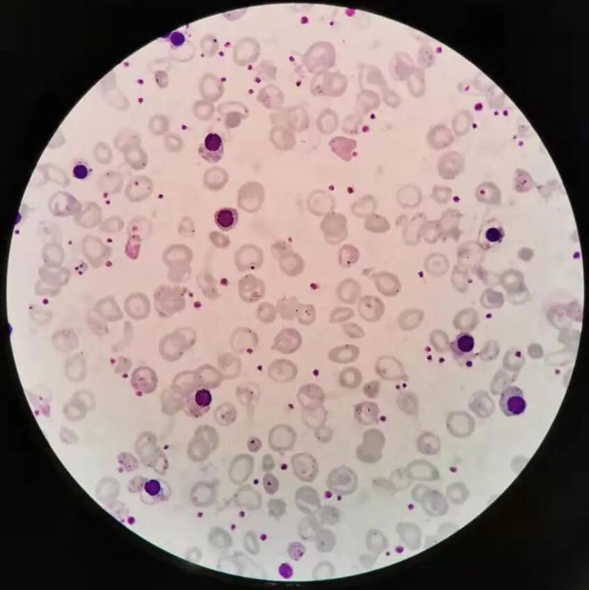 嗜碱性粒细胞增加;nrbc present:有核红细胞增加;ig present:未成熟粒