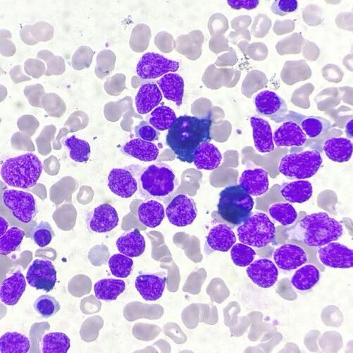 一例少见的淋巴瘤侵袭骨髓案例分享