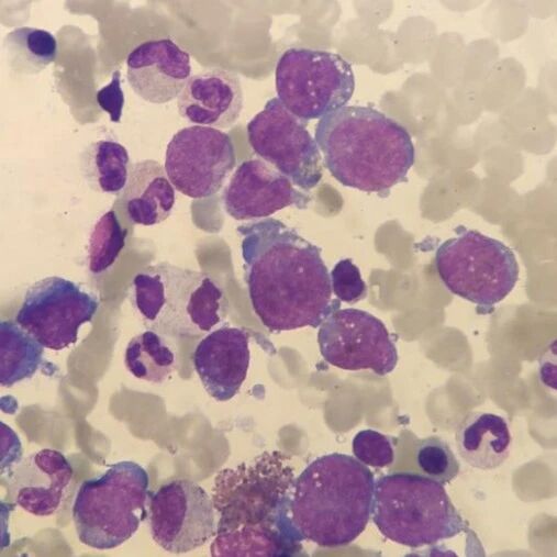 万万没想到……竟会同时原发两种血液肿瘤 | 先入为主，险酿大错