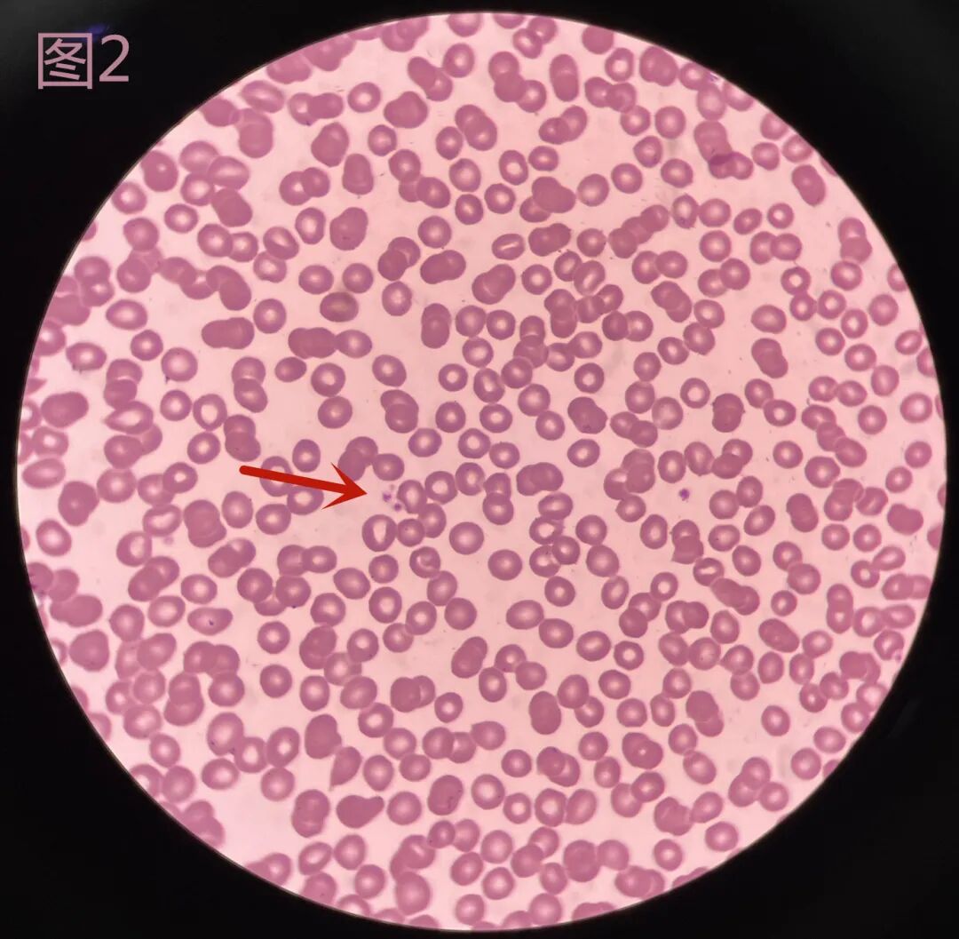 一例血小板聚集现象的血小板减少症病例_医学界-助力医生临床决策和