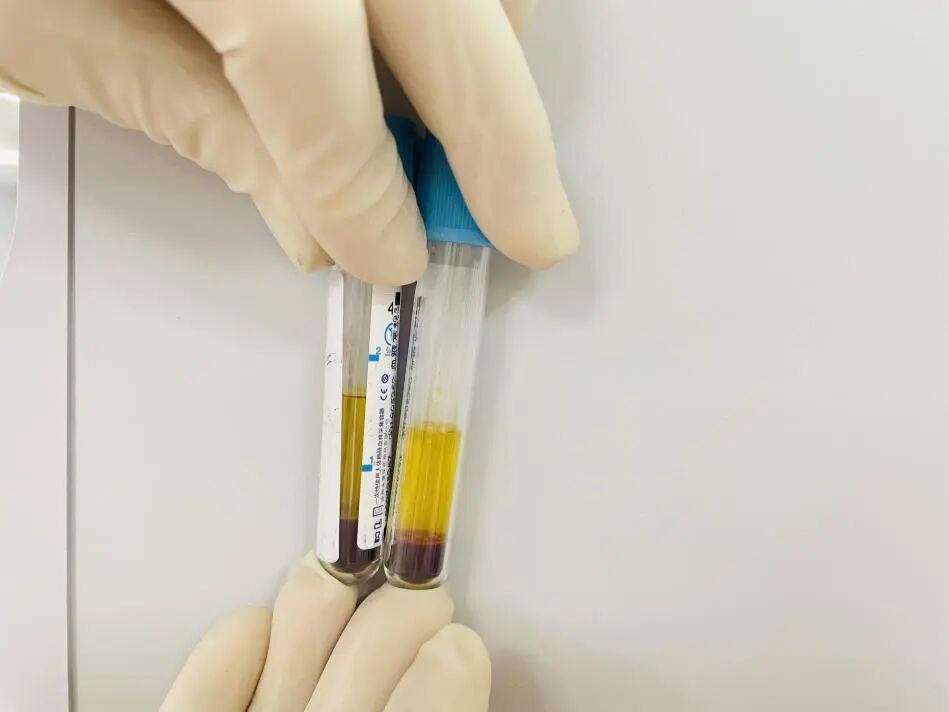 图3 抽血量对比(注:左侧为2ml抽血量测量后,右侧为1.