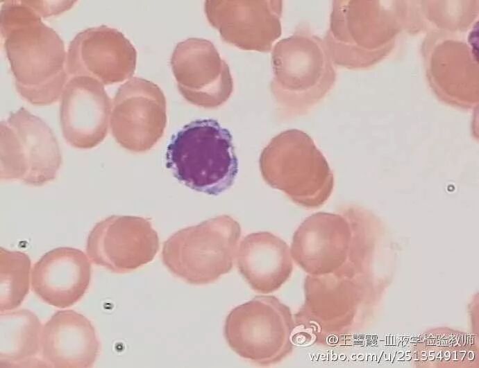 杜勒小体图片_杜勒小体_杜勒小体长得什么样子