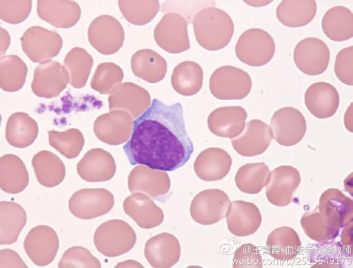 杜勒小体_杜勒小体长得什么样子_杜勒小体图片