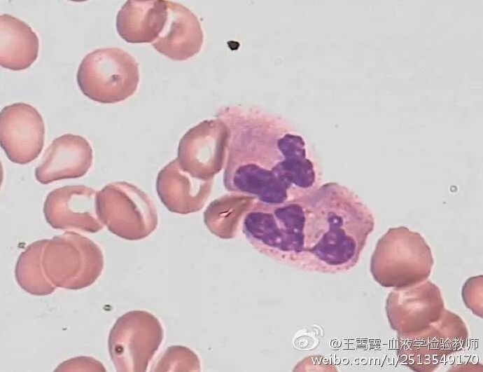 杜勒小体图片_杜勒小体_杜勒小体长得什么样子